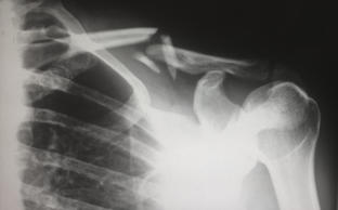X-ray of a broken shoulder