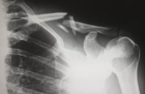 X-ray of a broken shoulder