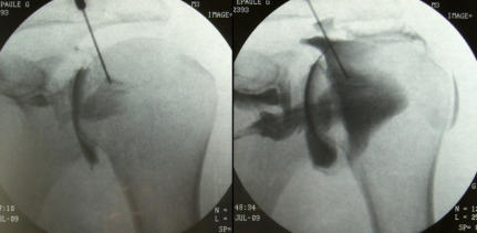 Image of shoulder being injected wtih solution for fluoroscopic arthrography