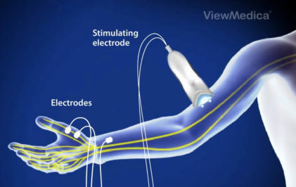 Illustration of a device checking nerve conduction in an arm
